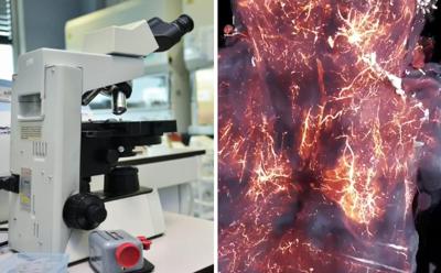Covid invade il cervello, ecco il 'film'. E la proteina Spike rimane per anni