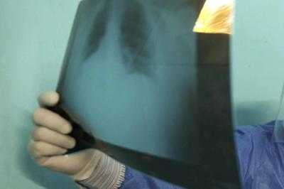 L'indagine, 63% dei post online su cancro al polmone riguarda terapie
