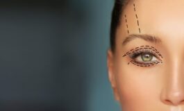 5 blefaroplastica 265x160