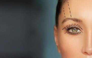 5 blefaroplastica 364x230