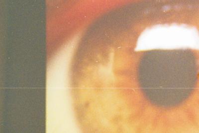 Rilancio Holostem, terapia salva-cornea a 1 paziente e gi&agrave; altri in lista