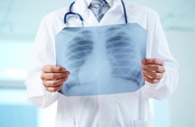 Adenocarcinoma polmonare, svelata carta d'identit&agrave; della variante mucinosa