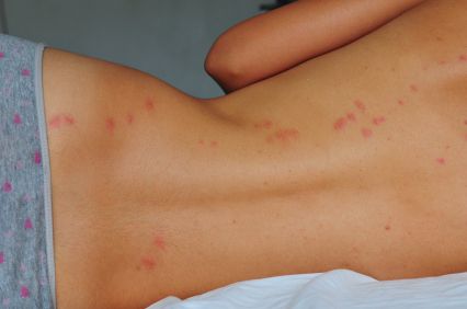 Insetti in inverno: come prevenire e trattare le loro punture