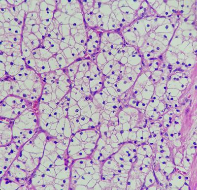 Studio, Tki e immunoterapia pi&ugrave; efficace di sunitinib in carcinoma a cellule renali