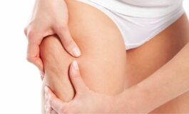 Ritenzione idrica: come contrastarla con l’alimentazione