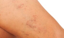 Vene varicose: cosa sono e come prevenirle