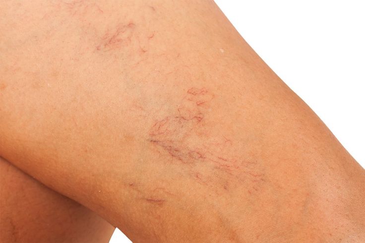 Vene varicose: cosa sono e come prevenirle