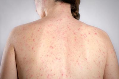 Morbillo, la verità sulla vitamina A: "Non riduce il rischio di contrarre la malattia"