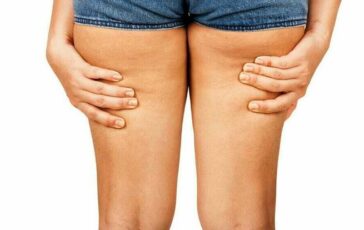 Ritenzione idrica: come eliminarla con la dieta e l’esercizio fisico