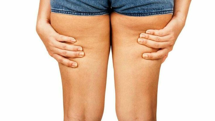 Ritenzione idrica: come eliminarla con la dieta e l’esercizio fisico