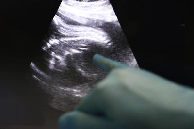 Trapianti, Uk, Amy prima bimba nata da donazione di utero da vivente