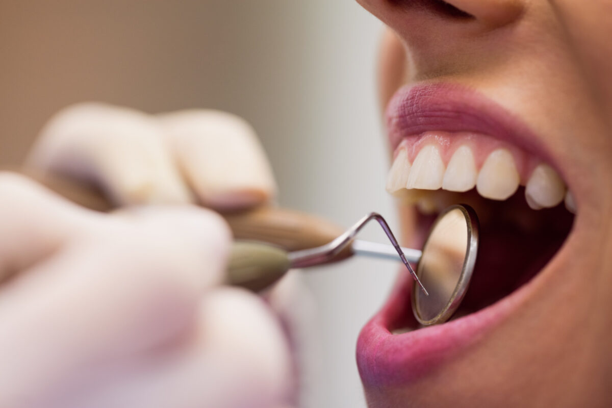 Come affrontare la perdita dei denti da adulti: tutte le soluzioni per sostituirli