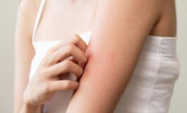 Allergie agli insetti: perché ne soffriamo e come rimediare