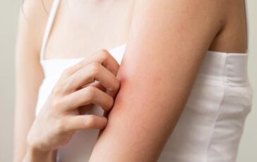 Allergie agli insetti: perché ne soffriamo e come rimediare