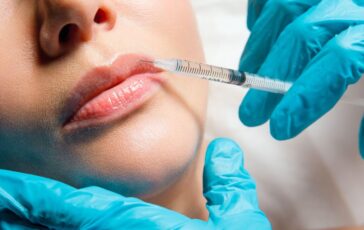 filler labbra social appartamento