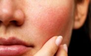 Couperose: cos’è e come curarla con i rimedi naturali