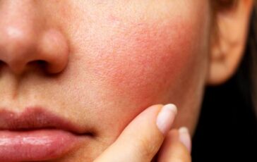 Couperose: cos’è e come curarla con i rimedi naturali