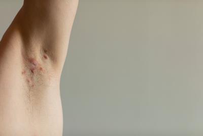 Idrosadenite suppurativa, appello esperti 'sia inserita nel Piano delle cronicit&agrave;'
