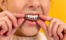Apparecchi trasparenti: il futuro dell’ortodonzia estetica