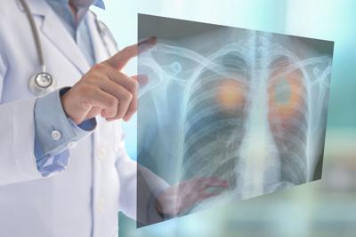 Tumori, nel 2050 i morti cancro supereranno i 18 milioni (+75%): lo studio su Lancet