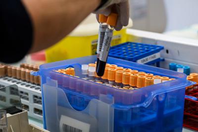 Fegato, un test per scoprire il rischio di gravi malattie entro 10 anni: lo studio