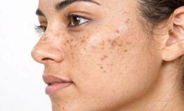 Macchie del sole sulla pelle: come difendersi naturalmente