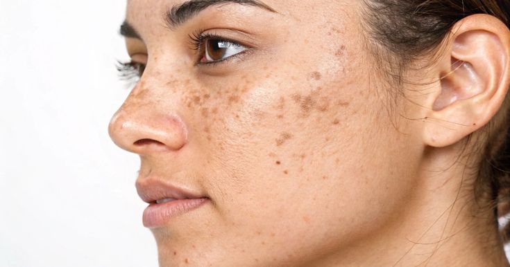 Macchie del sole sulla pelle: come difendersi naturalmente