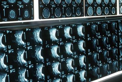 Ipofosfatemia legata all'X, primo bilancio e prospettive su linee guida