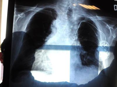 Polmonite, ogni anno in Italia 150mila ricoveri e 9mila morti: i sintomi