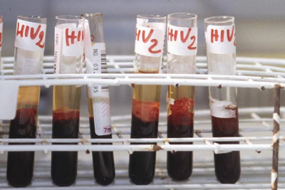 Hiv, oggi a Bari incontro su terapie long acting e prevenzione