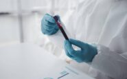 epatite a in forte crescita in italia lazio campania e puglia le regioni con piu casi 2