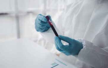 Epatite A in forte crescita in Italia Lazio Campania e Puglia le regioni con piu casi 364x230