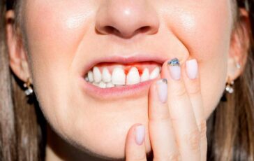 In Italia 9 mln con parodontiti piu cure soft e veloci per fermare boom casi 364x230