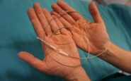 medicina filo sottile 15 mm contro morte cardiaca improvvisa a bergamo primi interventi 2