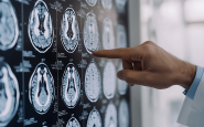 parkinson ansia e depressione possono essere segnali precoci lo studio 2