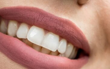 Sbiancare i denti in modo naturale