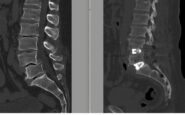 chirurgia vertebrale complessa al tiberia hospital di roma intervento con tecnica alif 2