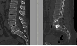Chirurgia vertebrale complessa al Tiberia Hospital di Roma intervento con tecnica Alif 265x160