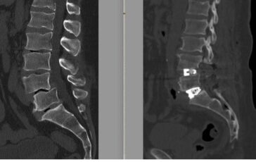Chirurgia vertebrale complessa al Tiberia Hospital di Roma intervento con tecnica Alif 364x230