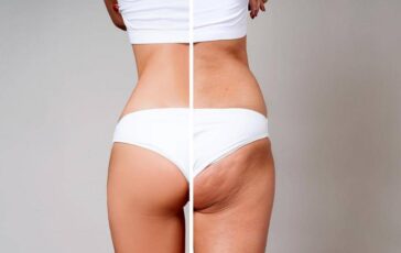 Gambe gonfie e cellulite per 8 donne su 10 la cura riparte dal sistema linfatico 364x230