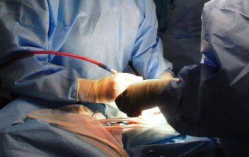 Interventi aorta 2 studi prevedono pazienti piu a rischio mortalita 364x230