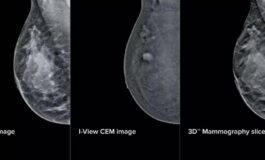 Mammografia intelligente al San Camillo di Roma aiutera gli specialisti nelle diagnosi 265x160