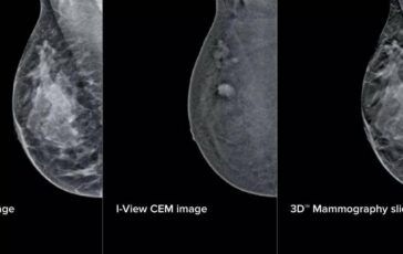 Mammografia intelligente al San Camillo di Roma aiutera gli specialisti nelle diagnosi 364x230