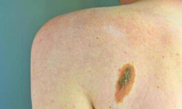 Ogni anno in Italia 2.600 casi ereditari di melanoma ImiPrevenzione con test genetici e controlli 265x160