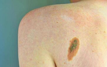 Ogni anno in Italia 2.600 casi ereditari di melanoma ImiPrevenzione con test genetici e controlli 364x230