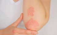 psoriasi dati positivi per inibitore orale di tyk2 di nuova generazione 2