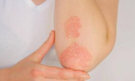 Psoriasi dati positivi per inibitore orale di Tyk2 di nuova generazione 265x160