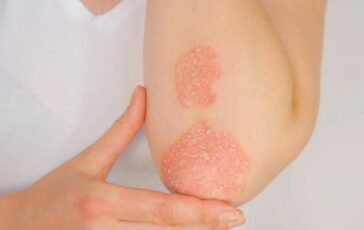 Psoriasi dati positivi per inibitore orale di Tyk2 di nuova generazione 364x230
