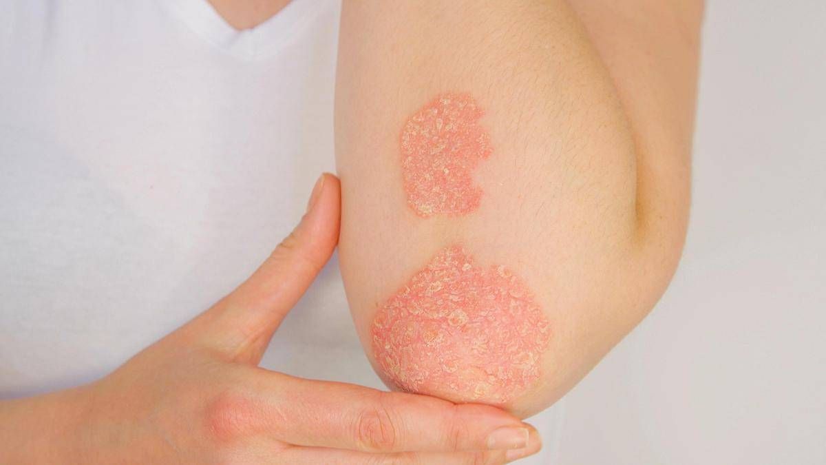 Psoriasi, dati positivi per inibitore orale di Tyk2 di nuova generazione