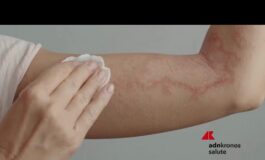 Psoriasi per 15 mln italiani oltre 750 visite gratuite nellOpen day nazionale 265x160